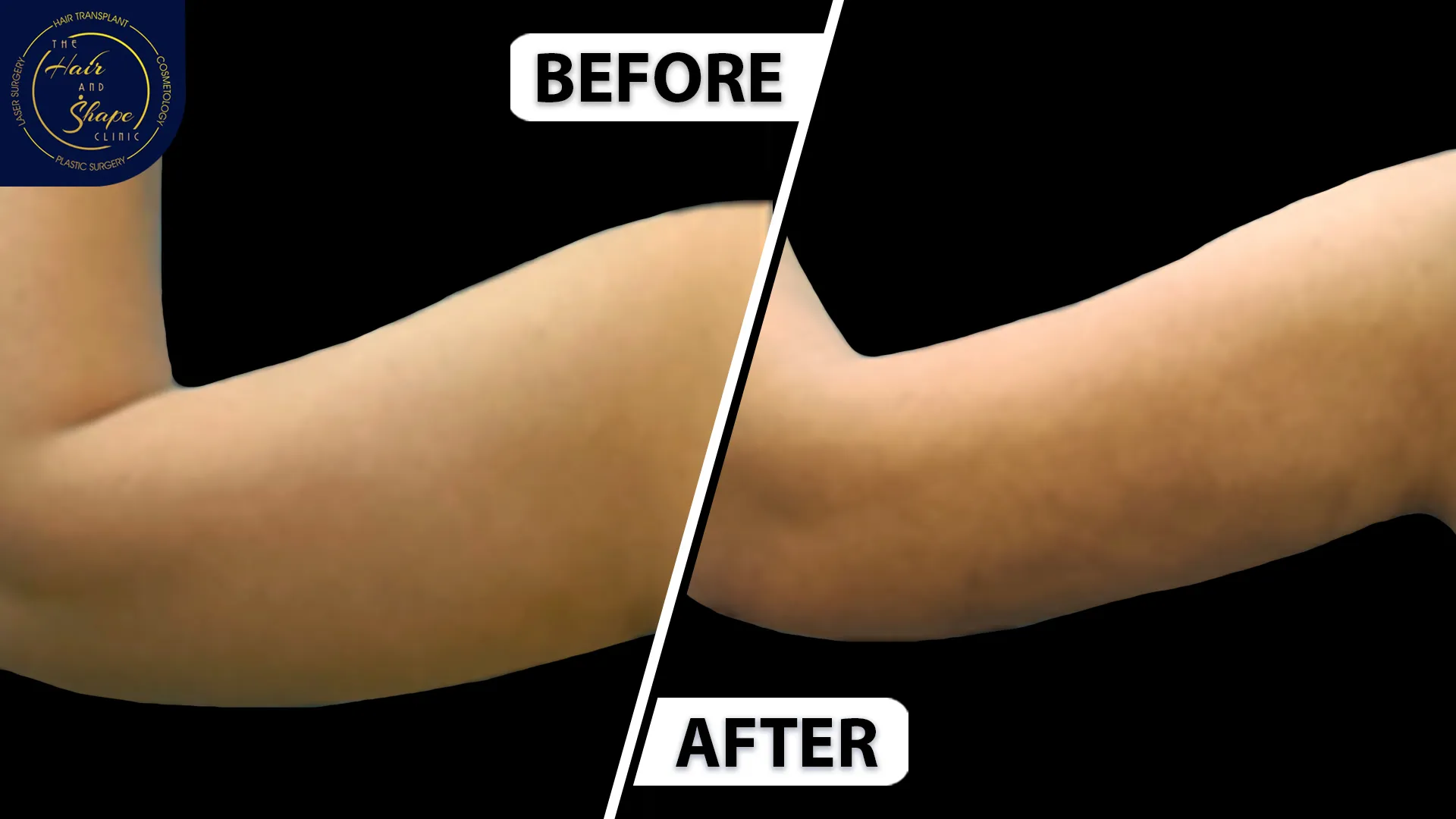 Arm lift result6